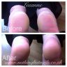 Callus peel results from 1 treatment